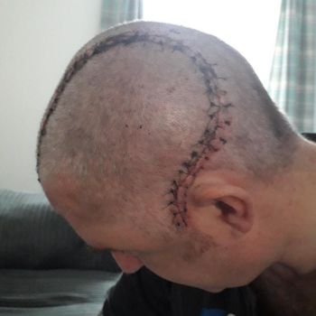 A large scar wrapping itself around David's skull