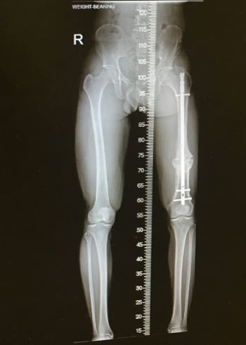 X-ray showing Rory's leg post surgery
