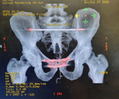 X-ray of Peter's pelvis