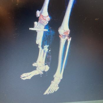 x-ray showing Zoltan's near amputation of his left lower leg