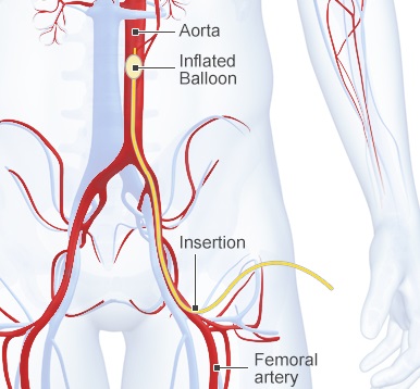 World’s first pre-hospital REBOA performed | London’s Air Ambulance